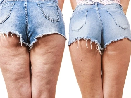 Продуктите за целулит са измама