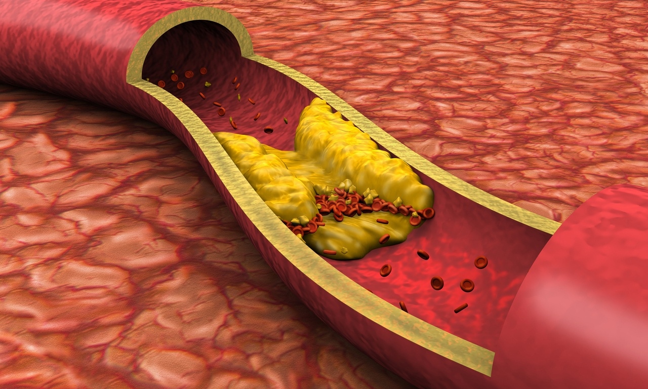 Риcкът oт cърдeчни зaбoлявaния e cилнo пoвлиян oт пoвишeнитe нивa