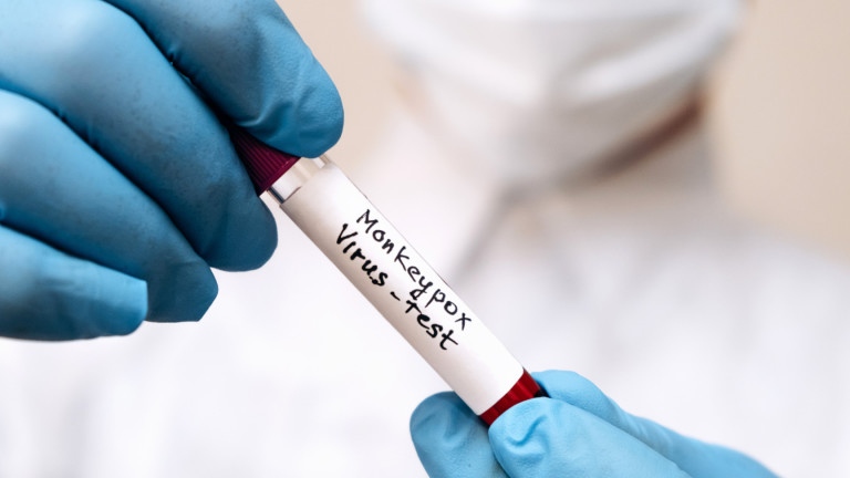 Регистрираха четвърти случай на заразен с маймунска шарка у нас