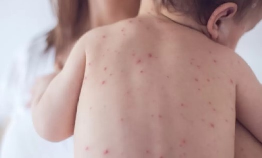 Налице е непосредствена глобална заплаха от разпространение на морбили в