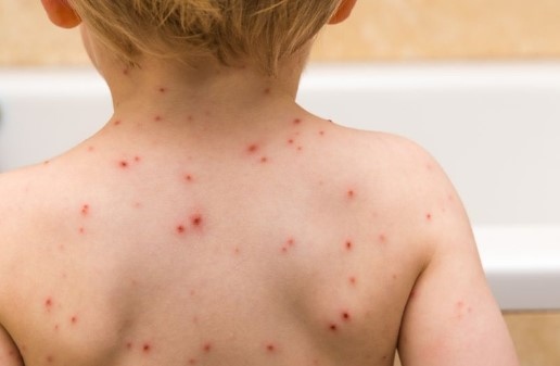 Рязък скок в броя на случаите на варицела у нас