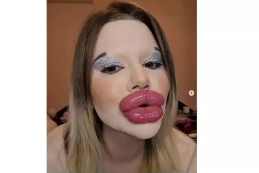 33 та рекордна вливка хиалурон ще си инжектира в устните БГ