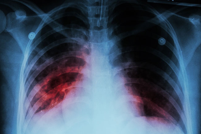 Безплатни прегледи за туберкулоза започват от днес в лечебни заведения