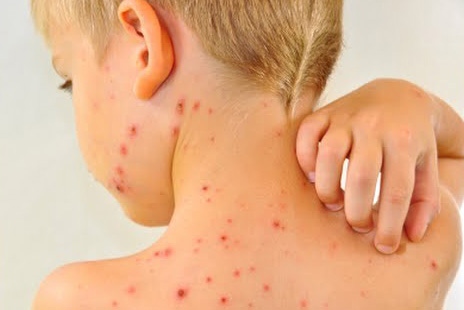 Увеличават се случаите на скарлатина и варицела в страната показват
