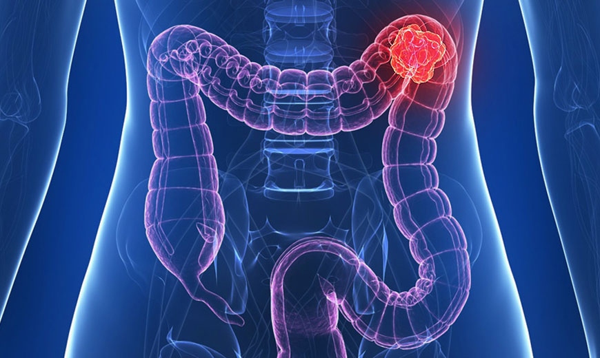 Случаите на рак на дебелото черво сред хората на възраст