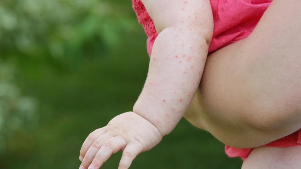 Епидемия от инфекциозното заболяване морбили е обявена в кантон Сараево