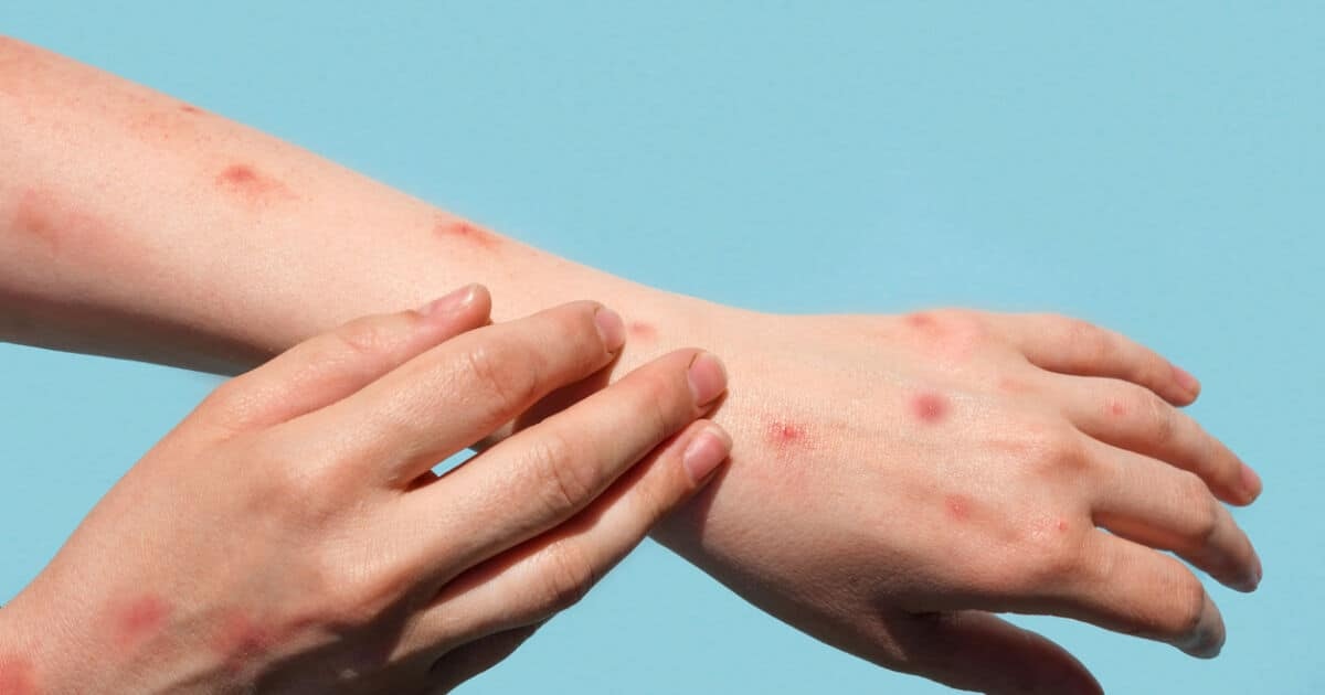 Неизбежно маймунската шарка ще се появи и в България Това